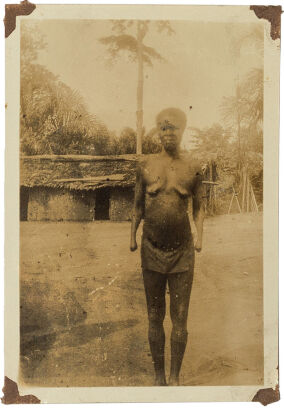 UNKNOWN PHOTOGRAPHER Belgian Congo woman, with hands cut off as a punishment for not meeting rubber quota in King Leopold's Congo of forced labour